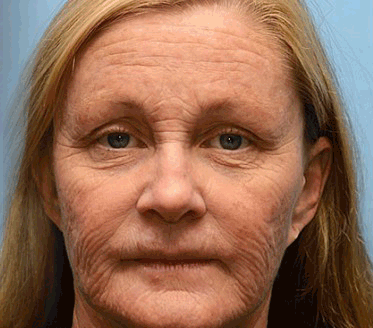 ✨ 🎁 Már csak az utolsó 5 doboz maradt! Korlátozott ideig extra 50% kedvezmény! Ragadd meg a lehetőséget a bőröd újjászületéséhez ✨Ha most lemaradsz, legközelebb csak jövőre lesz esélyed!